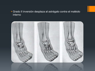  Grado II inversión desplaza al astrágalo contra el maléolo
interno
 