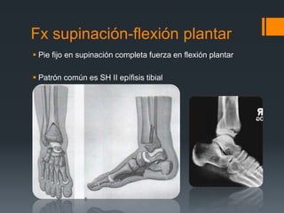 Fx supinación-flexión plantar
 Pie fijo en supinación completa fuerza en flexión plantar
 Patrón común es SH II epífisis tibial
 