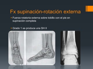 Fx supinación-rotación externa
 Fuerza rotatoria externa sobre tobillo con el pie en
supinación completa
 Grado 1 se produce una SH II
 