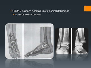  Grado 2 produce además una fx espiral del peroné
 No lesión de fisis peronea
 
