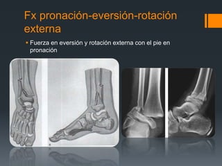 Fx pronación-eversión-rotación
externa
 Fuerza en eversión y rotación externa con el pie en
pronación
 
