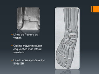  Línea de fractura es
vertical
 Cuanto mayor madurez
esquelética más lateral
será la fx
 Lesión corresponde a tipo
III de SH
 