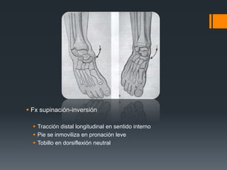  Fx supinación-inversión
 Tracción distal longitudinal en sentido interno
 Pie se inmoviliza en pronación leve
 Tobillo en dorsiflexión neutral
 