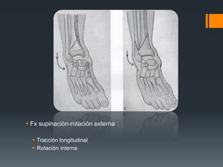  Fx supinación-rotación externa
 Tracción longitudinal
 Rotación interna
 