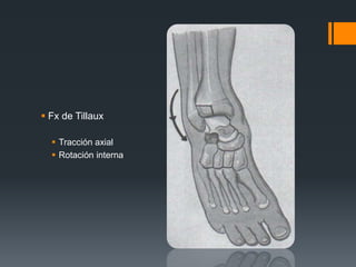  Fx de Tillaux
 Tracción axial
 Rotación interna
 