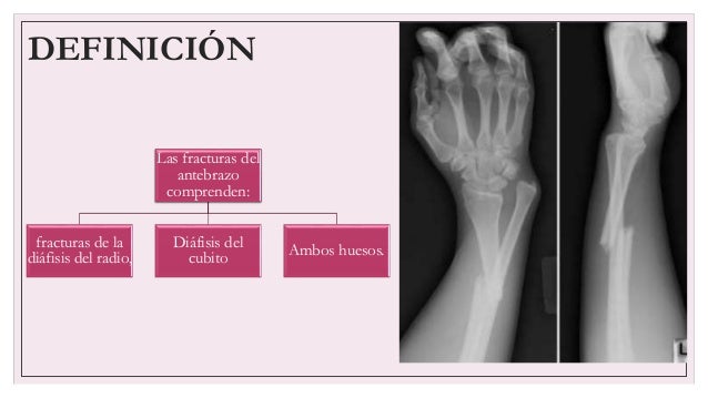 Fractura De La Diáfisis Del Cúbito Y Del Radio www.slideshare.net