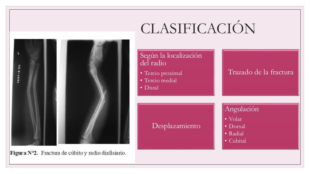 Fractura De La Diáfisis Del Cúbito Y Del Radio www.slideshare.net