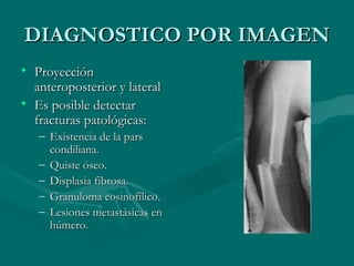 DDIIAAGGNNOOSSTTIICCOO PPOORR IIMMAAGGEENN 
• PPrrooyyeecccciióónn 
aanntteerrooppoosstteerriioorr yy llaatteerraall 
• EEss ppoossiibbllee ddeetteeccttaarr 
ffrraaccttuurraass ppaattoollóóggiiccaass:: 
– EExxiisstteenncciiaa ddee llaa ppaarrss 
ccoonnddiilliiaannaa.. 
– QQuuiissttee óósseeoo.. 
– DDiissppllaassiiaa ffiibbrroossaa.. 
– GGrraannuulloommaa eeoossiinnooffíílliiccoo.. 
– LLeessiioonneess mmeettaassttáássiiccaass eenn 
hhúúmmeerroo.. 
 