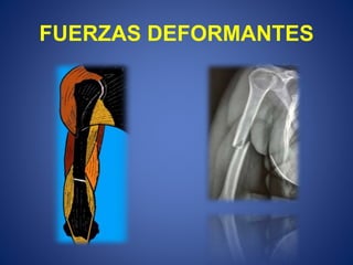 FUERZAS DEFORMANTES
 