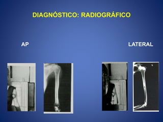 DIAGNÓSTICO: RADIOGRÁFICO
AP LATERAL
 
