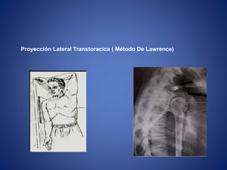 Proyección Lateral Transtoracica ( Método De Lawrence)
 