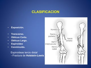 CLASIFICACION
• Exposición.
• Transverso.
• Oblicuo Corto.
• Oblicuo Largo.
• Espiroideo
• Conminuido.
Espiroideas tercio distal
- Fractura de Holstein-Lewis
 