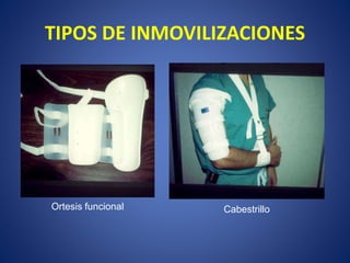 TIPOS DE INMOVILIZACIONES
• Yeso colgante (Caldwell 1933)
• Ferula en “u” (Böhler 1966)
• Vendaje Velpeau (Gilchrist 1967)
• Ferula en abducción (Holm 1970)
(Toraco braquial)
• Brace funcional (Sarmiento 1977)
• Tracción esquelética (Epps 1984)
Ortesis funcional Cabestrillo
 