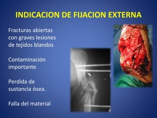 INDICACION DE FIJACION EXTERNA
Fracturas abiertas
con graves lesiones
de tejidos blandos
Contaminación
importante
Perdida de
sustancia ósea.
Falla del material
 