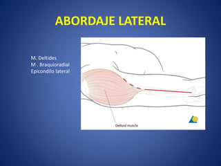 ABORDAJE LATERAL
M. Deltides
M . Braquioradial
Epicondilo lateral
 