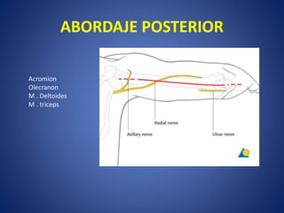 ABORDAJE POSTERIOR
Acromion
Olecranon
M . Deltoides
M . triceps
 