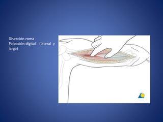 Disección roma
Palpación digital (lateral y
larga)
 