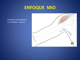 ENFOQUE MIO
Acromion anterolateral
m. Deltoides anterior
 