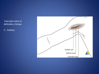 Intervalo entre el
deltoides y bíceps
V . Cefalica
 