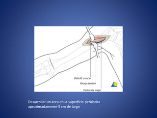 Desarrollar un área en la superficie perióstica
aproximadamente 5 cm de largo
 