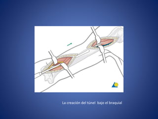 La creación del túnel bajo el braquial
 