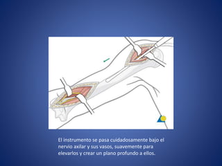 El instrumento se pasa cuidadosamente bajo el
nervio axilar y sus vasos, suavemente para
elevarlos y crear un plano profundo a ellos.
 