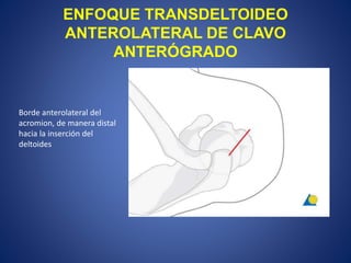 ENFOQUE TRANSDELTOIDEO
ANTEROLATERAL DE CLAVO
ANTERÓGRADO
Borde anterolateral del
acromion, de manera distal
hacia la inserción del
deltoides
 
