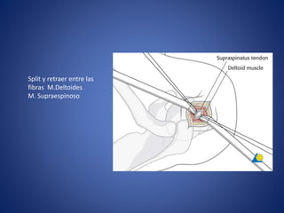 Split y retraer entre las
fibras M.Deltoides
M. Supraespinoso
 