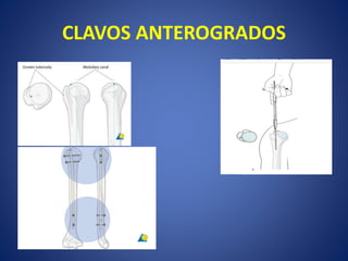 CLAVOS ANTEROGRADOS
 