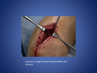 Exponer la región dorsal supracondílea del
húmero
 