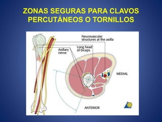 ZONAS SEGURAS PARA CLAVOS
PERCUTÁNEOS O TORNILLOS
 