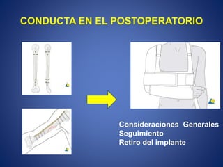 CONDUCTA EN EL POSTOPERATORIO
Consideraciones Generales
Seguimiento
Retiro del implante
 