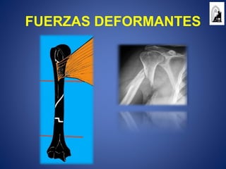 FUERZAS DEFORMANTES
 