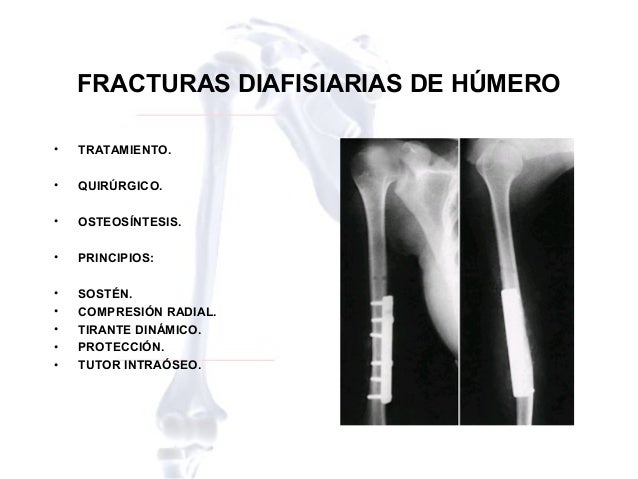 Fracturas diafisarias de humero (2)