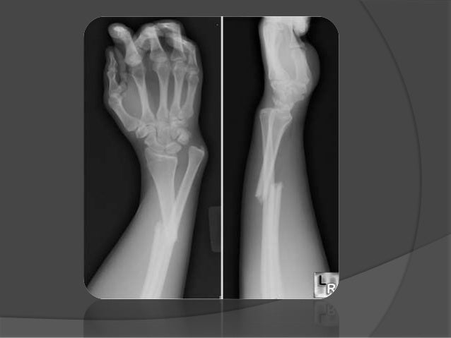 Fractura De La Diáfisis Del Cúbito Y Del Radio es.slideshare.net