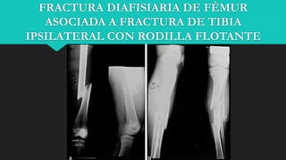 Ipsilateral Tibia Fracturas diafisiarias de Femur y Tibia MSR y LMG.pptx