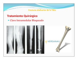Fracturas diafisarias de la Tibia

Tratamiento Quirúrgico
 Clavo Intramedular Bloqueado
 