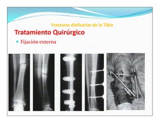 Fracturas diafisarias de la Tibia
Tratamiento Quirúrgico
 Fijación externa
 