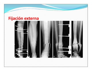 Fijación externa
 