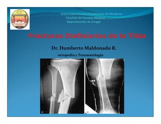 Fracturas Diafisiarias de la Tibia
      Dr. Humberto Maldonado R.
        ortopedia y Traumatología
 