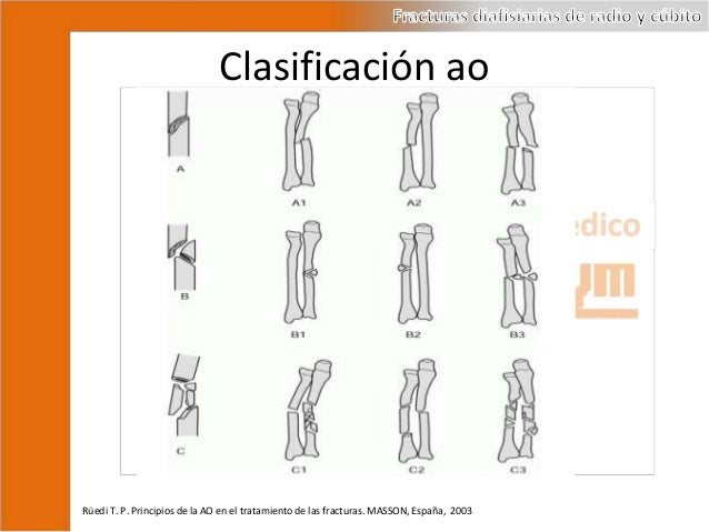 Fractura De La Diáfisis Del Cúbito Y Del Radio www.slideshare.net