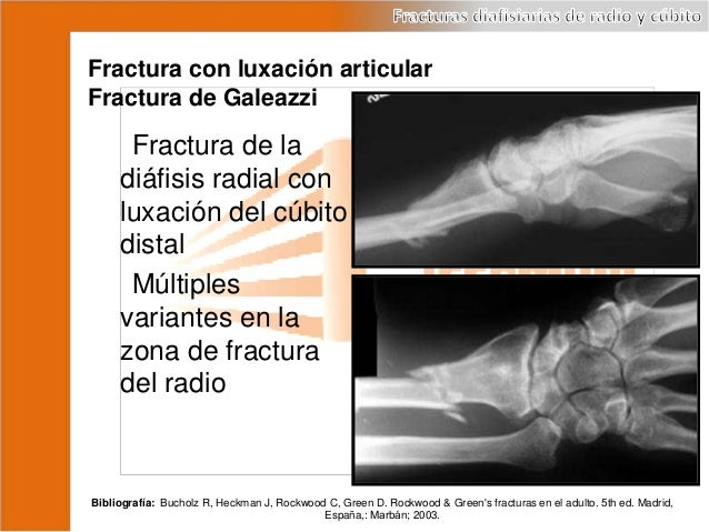 Fractura De La Diáfisis Del Cúbito Y Del Radio www.slideshare.net
