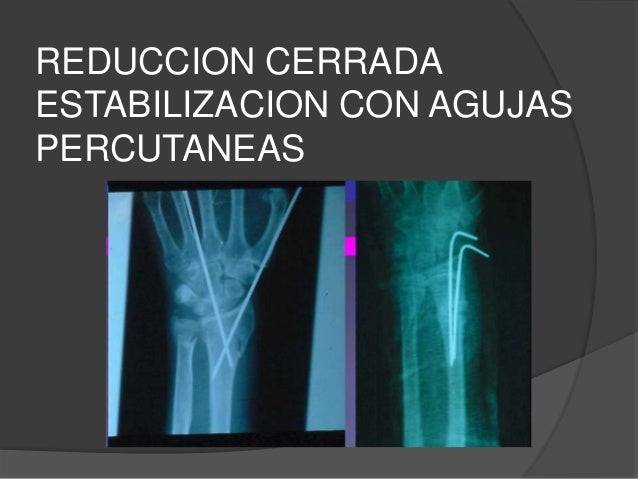 pilon fracture icd 9 code pilon fracture icd 9 code