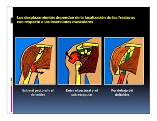Los desplazamientos dependen de la localización de las fracturas
con respecto a las inserciones musculares




  Entre el pectoral y el   Entre el pectoral y el   Por debajo del
       deltoides              sub-escapular           deltoides
 