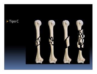 Tipo C
 