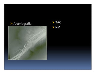  Arteriografía    TAC
                   RM
 