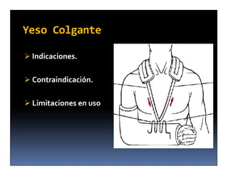 Yeso Colgante

 Indicaciones.


 Contraindicación.


 Limitaciones en uso
 
