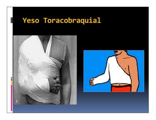 Yeso Toracobraquial
 