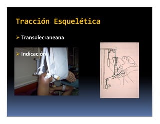 Tracción Esquelética
 Transolecraneana


 Indicación
 