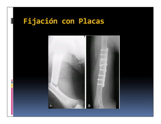 Fijación con Placas
 